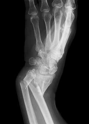 broken bones